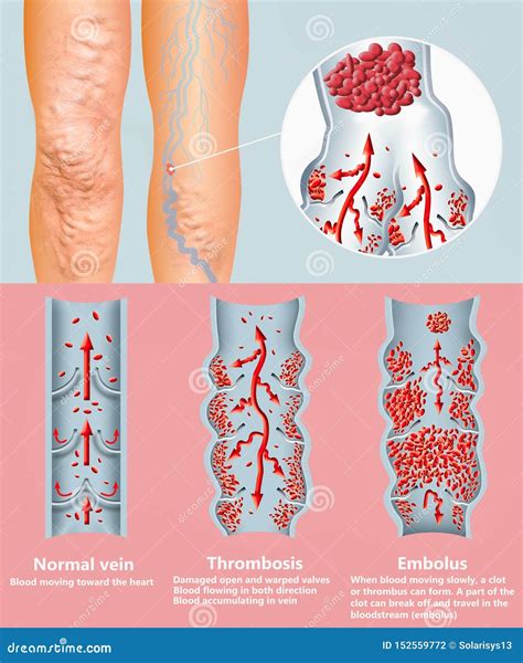 Deep Vein Thrombosis Or Blood Clots Embolus Stock Photo Image Of