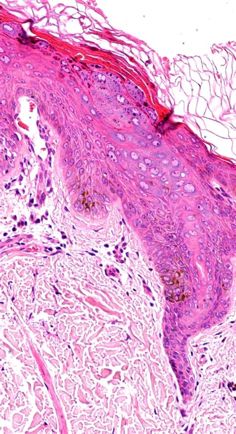 Pathology Of Epidermodysplasia Verruciformis