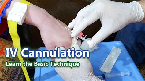 Iv Cannulation Procedure | edu.svet.gob.gt