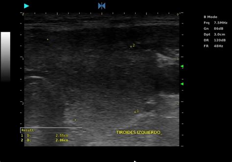 Graves Disease On Ultrasound Image