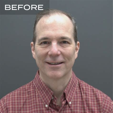 Hair Transplant Recovery - Hair Transplant Philadelphia