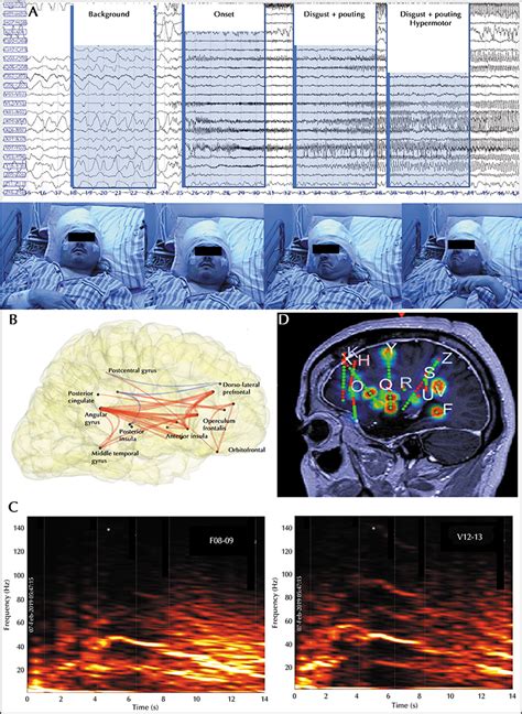 JLE Epileptic Disorders Motor And Emotional Facial Features In