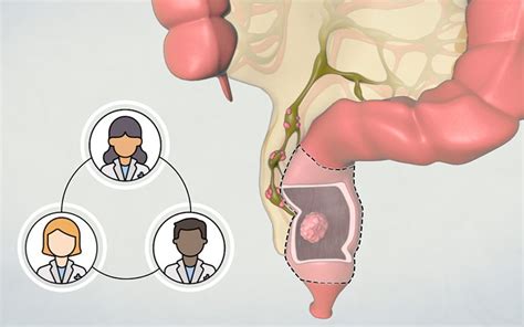 Patient Learning Left Hemicolectomy Sigmoid Colectomy Tvasurg The Toronto Video Atlas Of