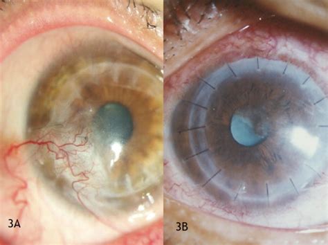 Risk Factors Clinical Features And Outcomes Of Recurrent Fungal Keratitis After Corneal