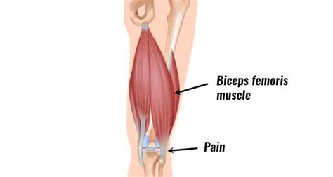 Biceps Femoris Muscle Pull Cause Diagnosis Treatment Exercise