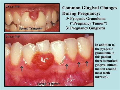 Gingival Pyogenic Granuloma