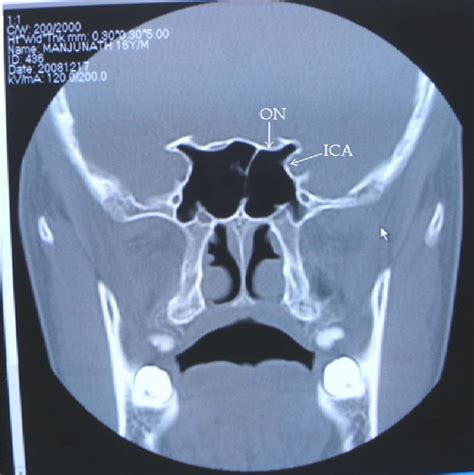 Figure 1 From Variations Of Sphenoid Sinus And Their Impact On Related