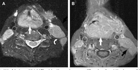 Figure 2 From Imaging Hodgkin And Non Hodgkin Lymphoma In The Head And Neck Semantic Scholar