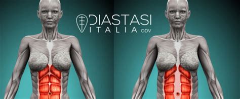 Diastasi Addominale Post Parto Sintomi Diagnosi Intervento