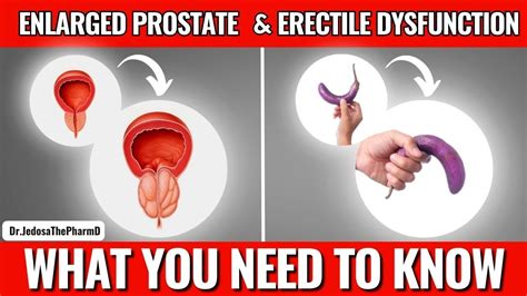 Enlarged Prostate And Erectile Dysfunction The Facts Every Man Should