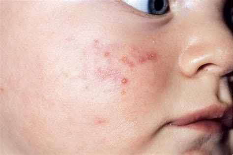 Children Rashes And Spots With Pictures Madeformums