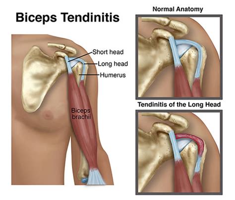 Biceps Tendinitis Causes Symptoms Treatment Dr Kaushik