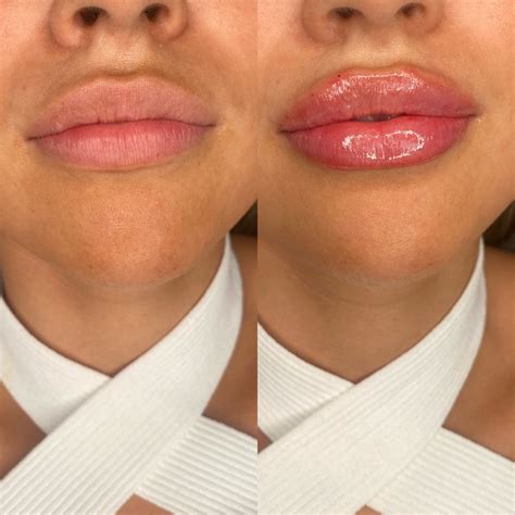 Good Lip Injections Before And After