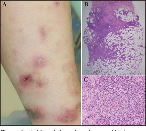 Figure From Erythema Induratum Nodular Vasculitis Associated With