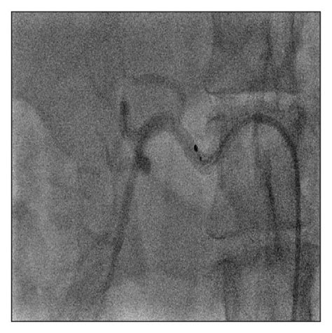 Catheter Based Renal Artery Denervation Procedure Download Scientific Diagram