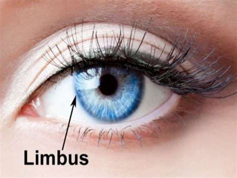 Limbus