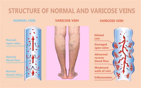 What Causes Vein Disorders Vein Specialists Of The Carolinas