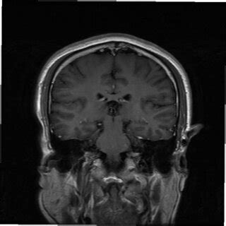 Brain MRI showed no obvious abnormalities, T1 weighted image coronal ...