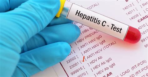 Testing for hepatitis C | Hepatitis Australia