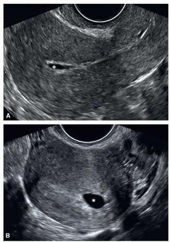 Fetal Biometry And Pregnancy Dating In The First Trimester Radiology Key