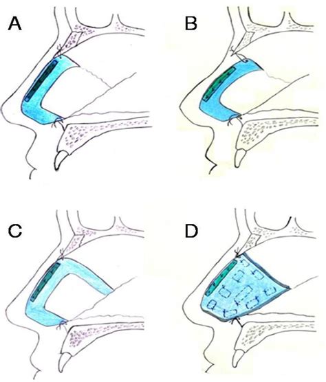 Schematic Diagram Of The Technique A Reconstructed Nasal Septum With