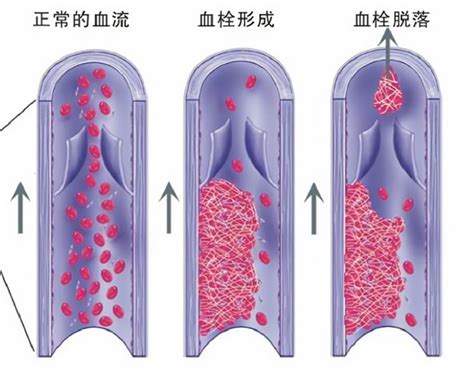 下腔深静脉血栓模型 动物造模 知乎