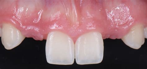 Three Solutions For Congenitally Missing Lateral Incisors Spear Education