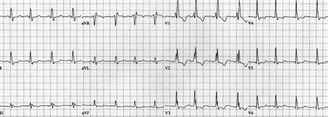 Lmca Occlusion St Elevation In Avr • Litfl • Ecg Library Diagnosis