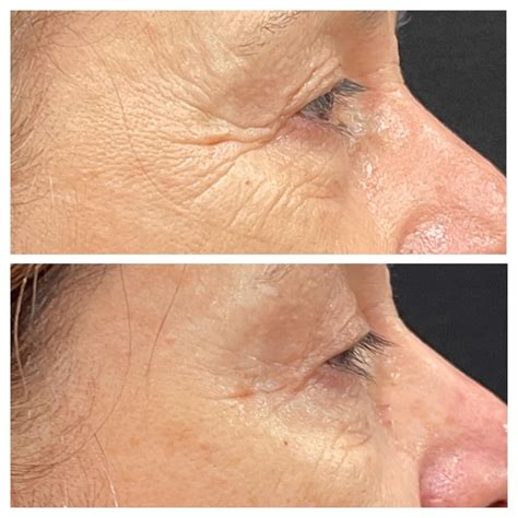 Non Surgical Eye Lift Exilis Ultra Rejuve Medspa Newcastle