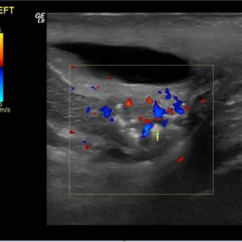 -Ultrasound scan of left epididymis shows thickening of epididymal tail... | Download Scientific ...