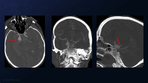 Pterional Craniotomy For Clipping Of A Posterior Communicating Artery