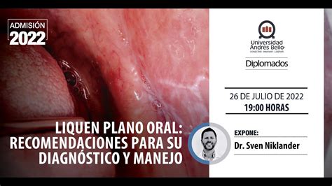 Webinar Liquen Plano Oral Recomendaciones Para Su Diagnóstico Y Manejo Youtube