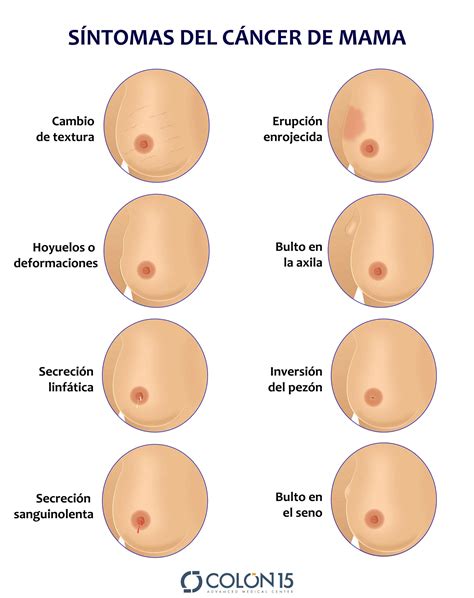 Parte H Medo Estaci N De Ferrocarril Imagenes De Cancer De Mama Inicial