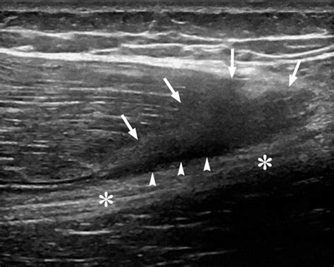 Gastrocnemius Tear Ultrasound