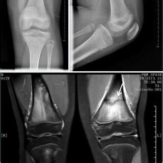 A And B Preoperative X Rays Showing Trimalleolar Fractures With