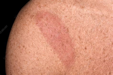 Identifying Lyme Disease Rash