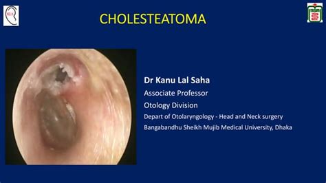 Cholesteatoma Ppt