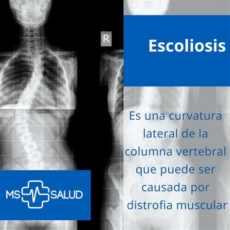 Escoliosis Síntomas Y Diagnóstico Certero Ms Más Salud