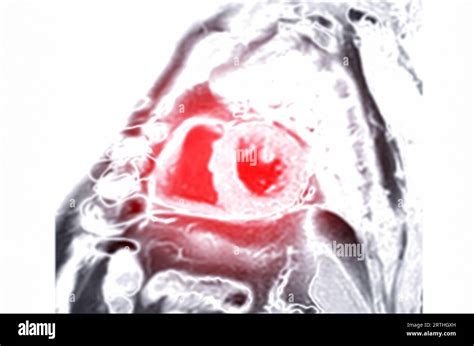 Mri Heart Or Cardiac Mri Magnetic Resonance Imaging Of Heart Short