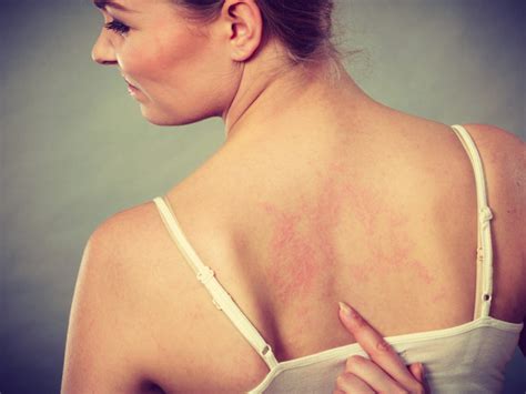 Inverse Psoriasis Causes And Treatments