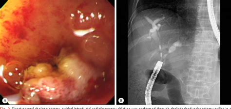 Figure 2 From A Case Of Direct Peroral Cholangioscopy Guided