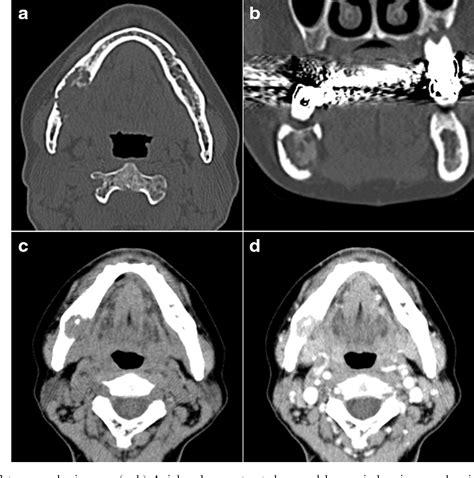 Figure 2 From Solid Type Primary Intraosseous Squamous Cell Carcinoma