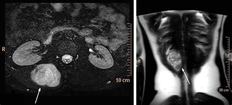 Malignant Peripheral Nerve Sheath Tumor Presented With Back Pain And