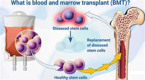 Best Clinics For Bone Marrow Transplant In India W Prices