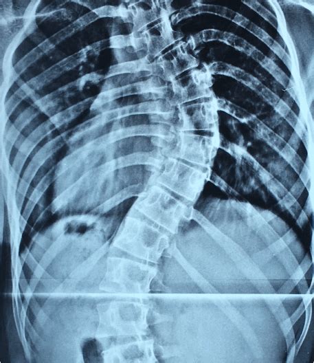 Escoliosis Idiopática Columna Vertebral Guadalajara Dr Javier Ramos