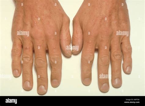 Granuloma Annulare On Hands