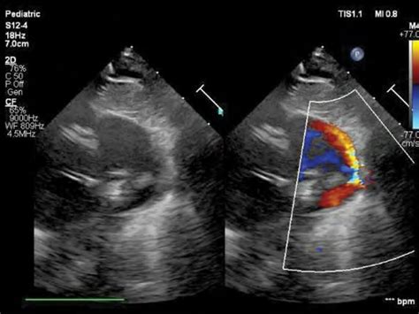 Persistenta De Canal Arterial Pca Cardioped Ro