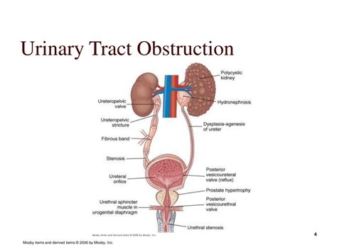 Ppt Alterations Of Renal And Urinary Tract Function Powerpoint