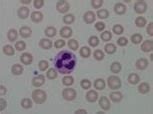 (a) A normal blood smear image and (b) microcytic hypochromic, (c ...