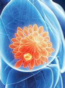 Exploring Targeted Therapy For Her Positive Metastatic Breast Cancer